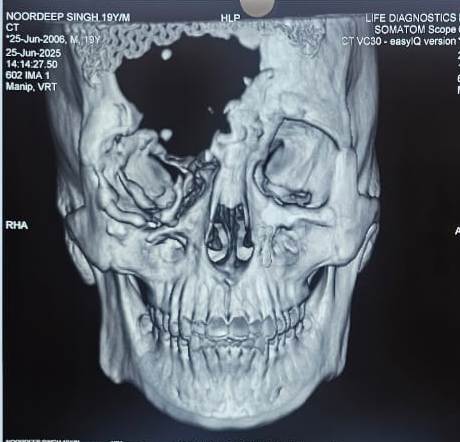 Broken skull side view