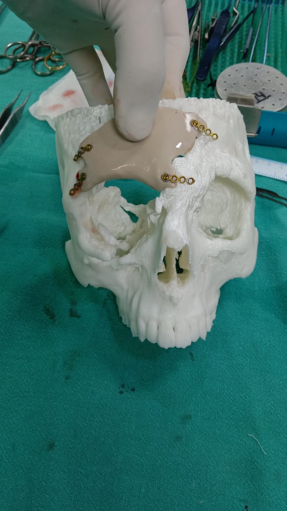 Broken skull front view